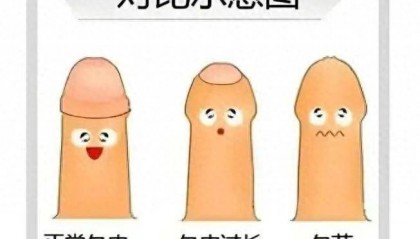 医生提醒不要盲目跟风割包皮 这些情况才需“动刀”