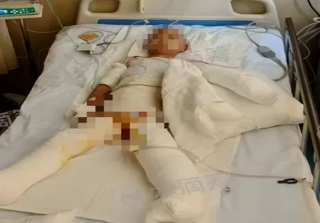 河南汝州33岁女子做饭时煤气突然爆炸，7岁女儿瞬间被火势冲到1米外，两人严重烧伤