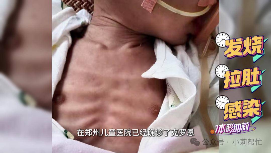 婴儿竟确诊克罗恩！出生5个月体重仅7斤，14次住院进了7次ICU，全身皮包骨头，扎针都扎不上！