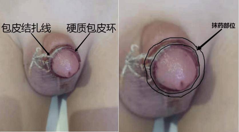 割完包皮后，多久能洗澡？